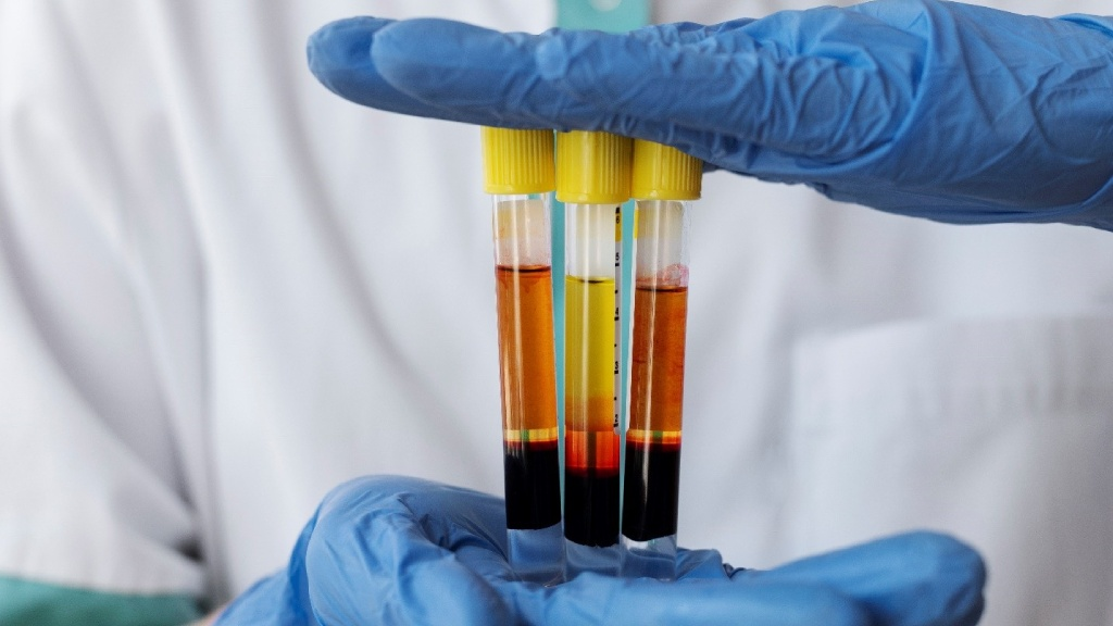 Why Clinicians Are Turning to PCR Urine Culture for More Accurate Faster UTI Diagnosis